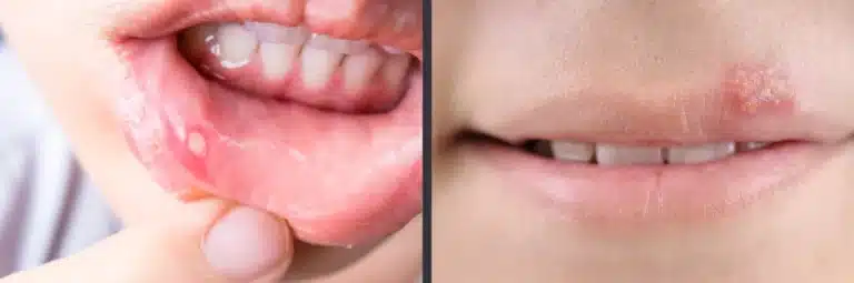 SMART Blog 10 Close-ups illustrating a canker sore and a cold sore