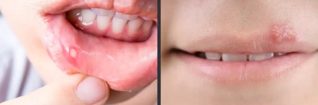 Canker/Cold Sores: How to Treat Them? 1 Close-ups illustrating a canker sore and a cold sore