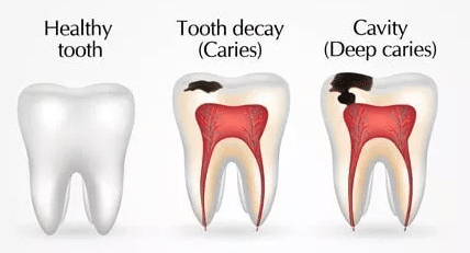 SMART Blog 9 Diagram comparing a healthy tooth, tooth decay and a deep cavity