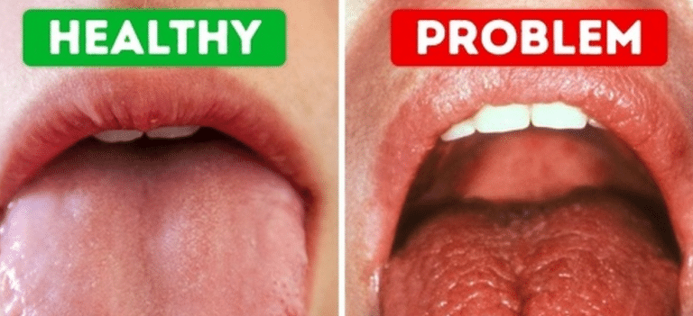 SMART Blog 5 Comparison of a healthy mouth and a dry mouth