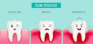 SMART Blog 2 Diagram showing stages of gum disease