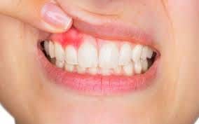 SMART Blog 6 Close-up of gums during an oral examination