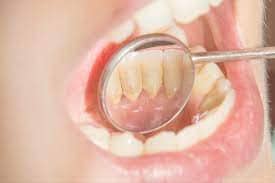 SMART Blog 7 Dental mirror showing plaque on teeth